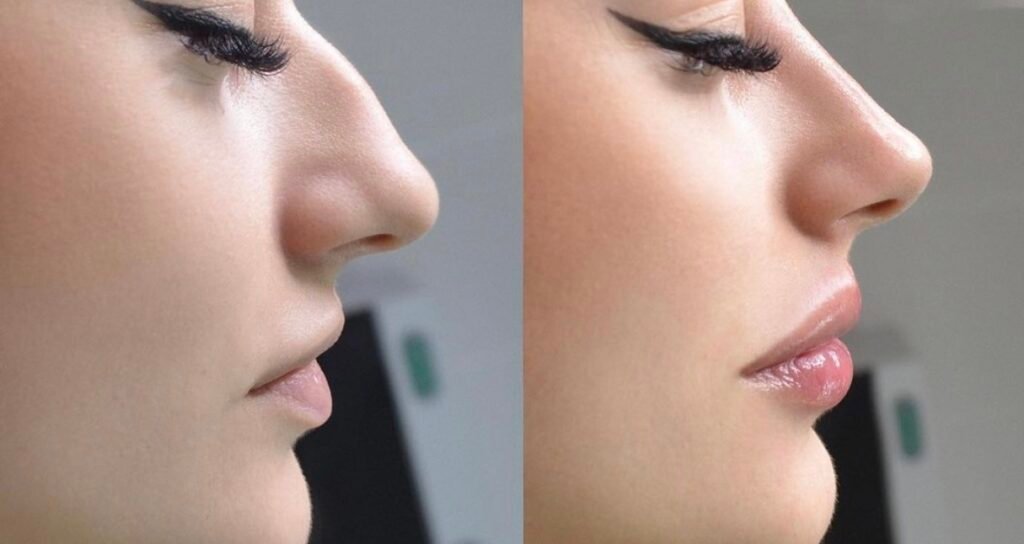 Threads nose