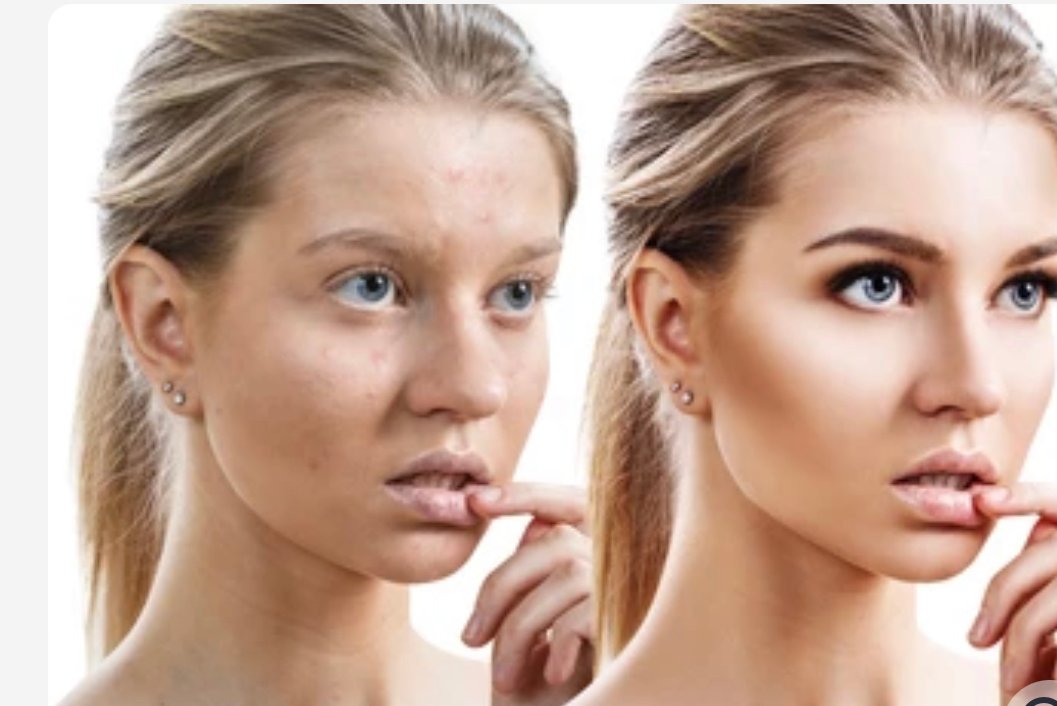 MICRODERMABRASION